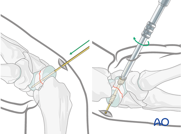 Percutaneous screw fixation with combined approaches for Scaphoid waist ...