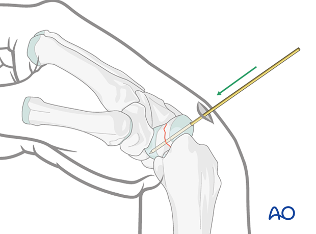 The guide wire is inserted percutaneously through the axis of the scaphoid during scaphoid – Undisplaced waist fracture – Percutaneous screw fixation