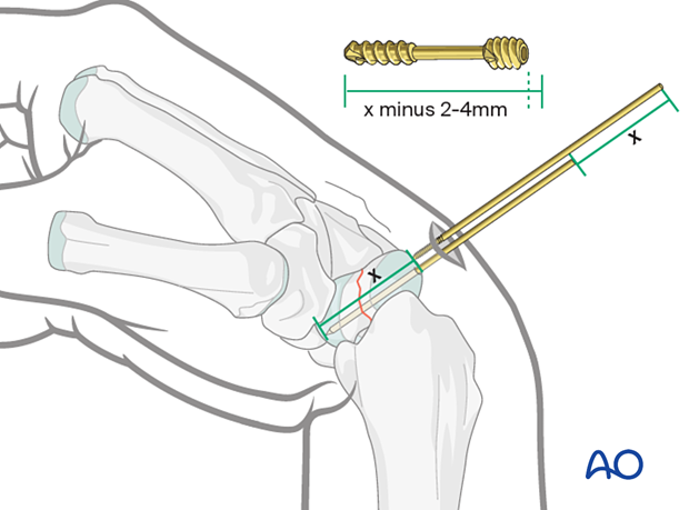 Determining screw length during scaphoid – nondisplaced waist fracture procedure.