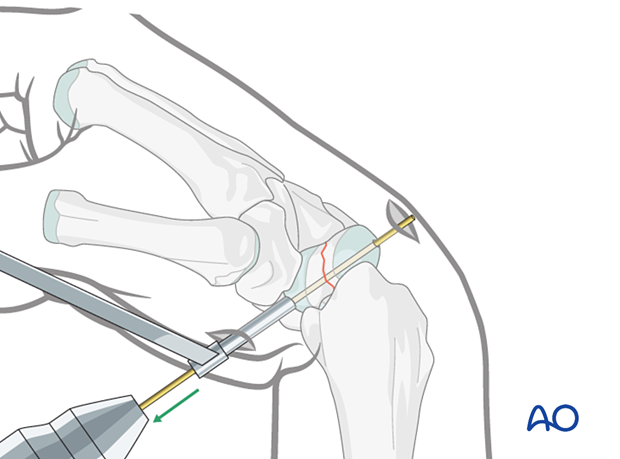 Advancing the guide wire during scaphoid – nondisplaced waist fracture procedure.