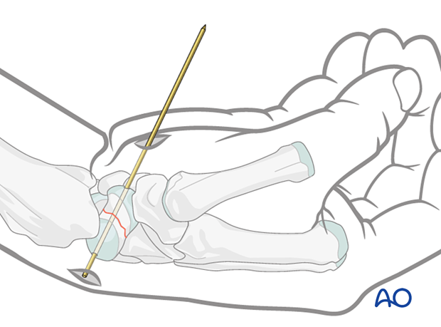 Screw insertion during Scaphoid – Undisplaced waist fracture – Percutaneous screw fixation.