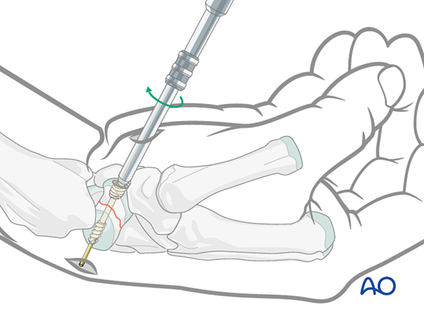 Inserting a headless compression screw during Scaphoid – Undisplaced waist fracture – Percutaneous screw fixation.