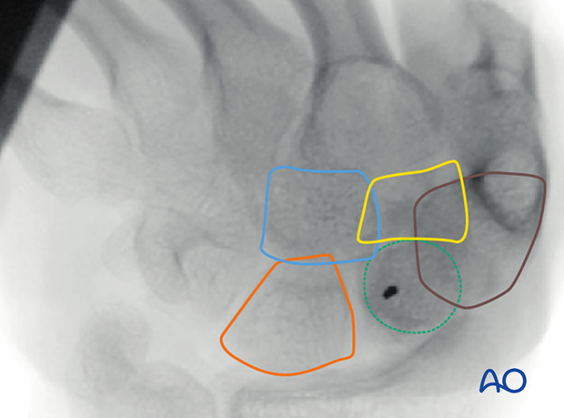 On the AP view with the wrist in palmar flexion the position of the following are indicated: Lunate (red), Capitate (blue), Trapezoidal (yellow), Trapezoid (brown)