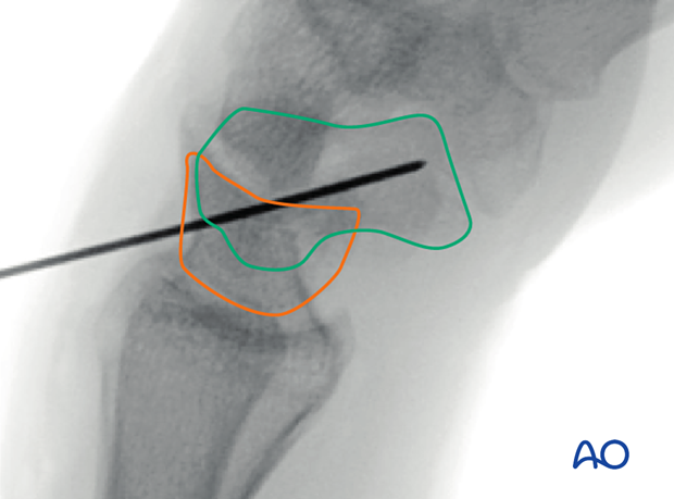 Lateral view of the wrist in flexion with the scaphoid and lunate outlined