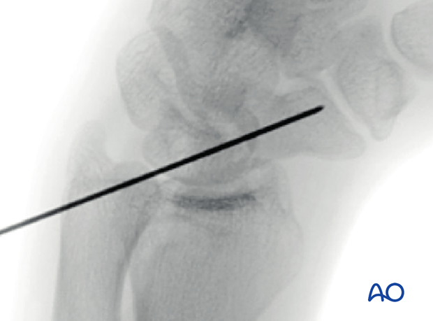 Oblique view (with the wrist in palmar flexion) during scaphoid – undisplaced waist fracture procedure, confirming that the guide wire is close to the scaphoid axis.