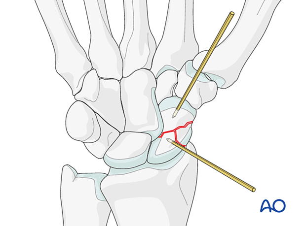 Scaphoid displaced waist fracture – direct reduction with K-wire joystick technique