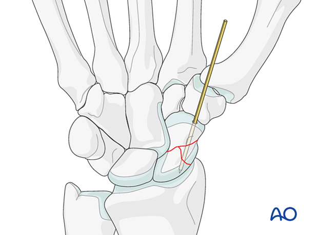 Scaphoid displaced waist fracture – temporary K-wire fixation