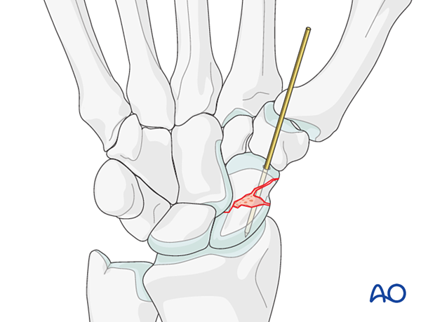 Bone graft added to a multifragmentary scaphoid waist fracture