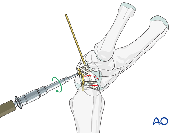 Multifragmentary scaphoid waist fracture fixed with a plate – Screw insertion