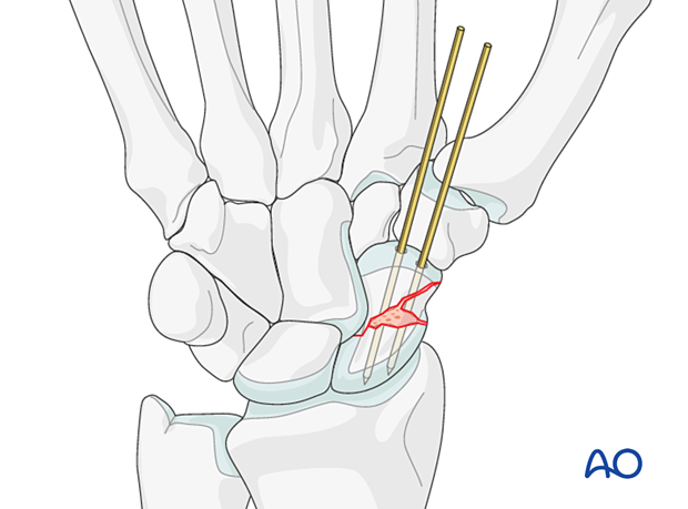 Use of bone graft in carpal bones 