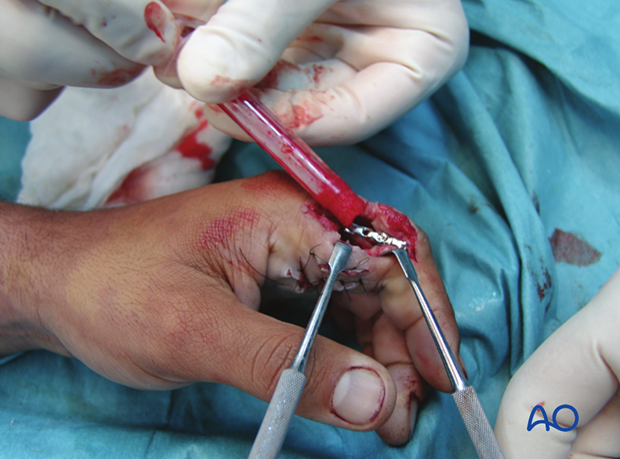 Insertion of bone graft into cavity