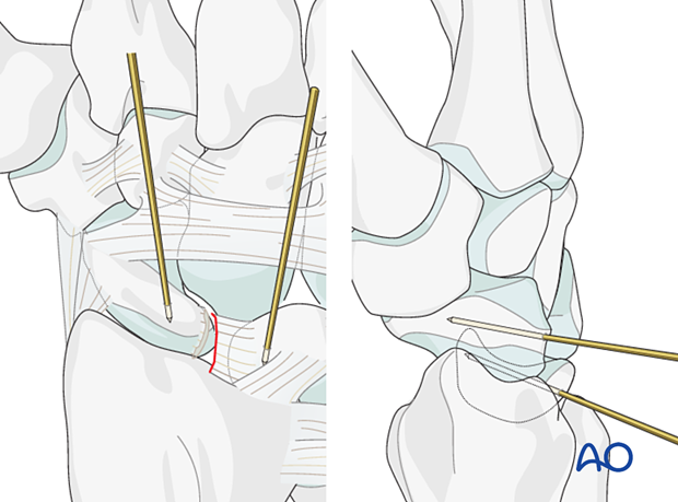 Insertion of a joystick K-wire into both the scaphoid and the lunate.