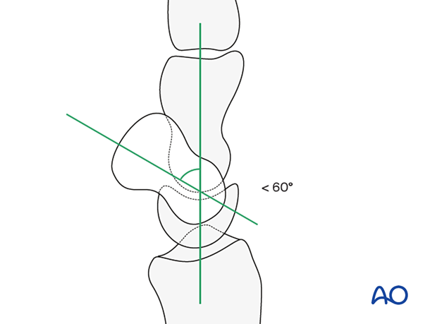 Checking the correct scaphoid and lunate alignment