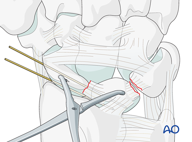 Lesser arc, lunate dislocation – transfixation of the scapholunate joint