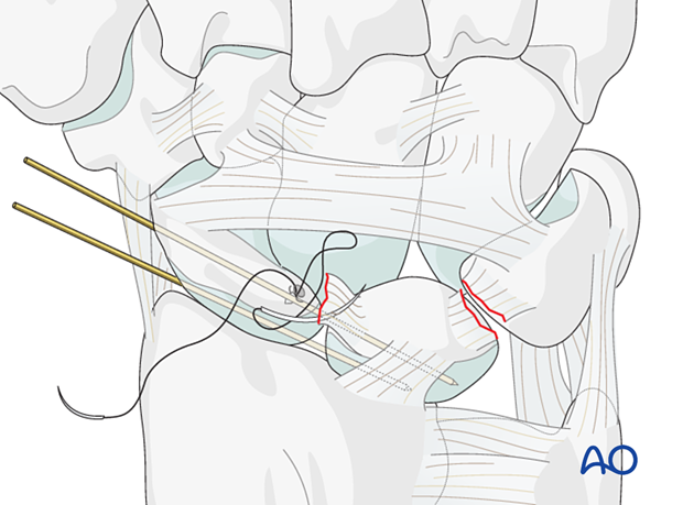 Lesser arc, lunate dislocation – insertion of a suture anchor into the torn end of the ligament and tying it.