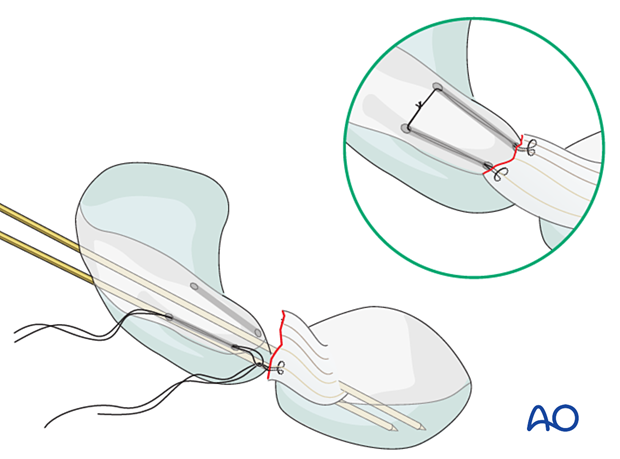 Lesser arc, lunate dislocation – transosseous ligament refixation