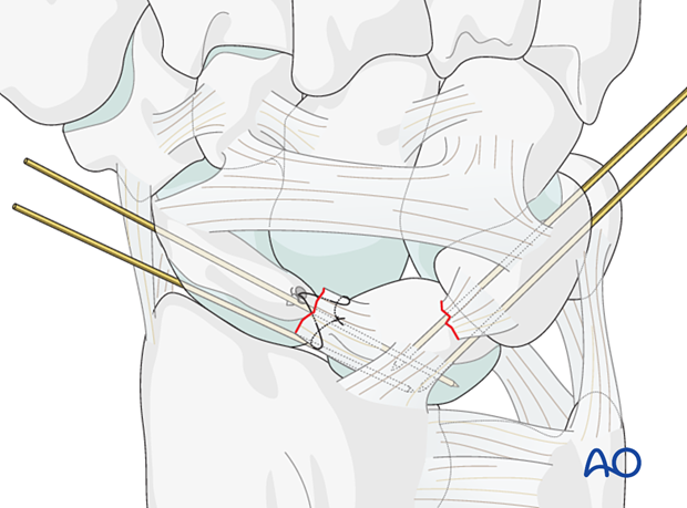 Lesser arc, lunate dislocation – inserting K-wires percutaneously from the triquetrum into the lunate