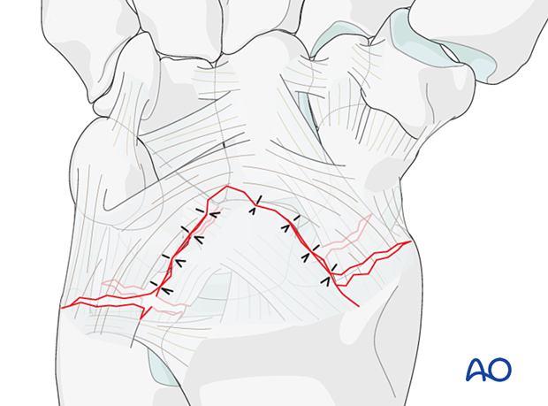 Lesser arc, lunate dislocation – revision through a palmar approach