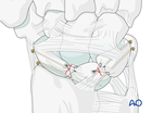 Lesser arc, lunate dislocation – open reduction ligament repair