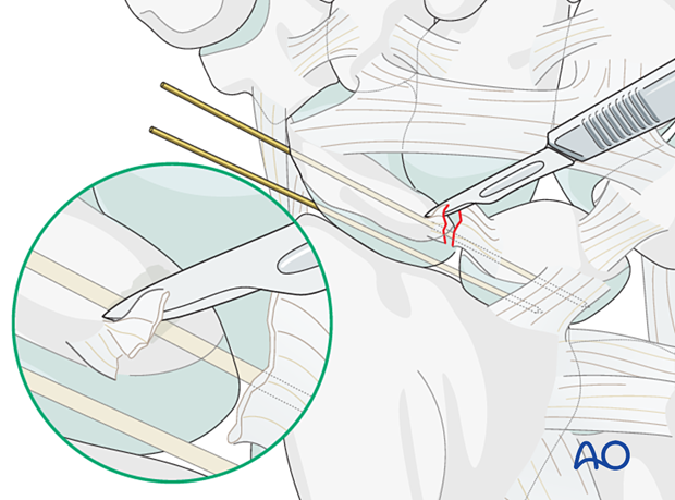 Lesser arc, scapholunate ligament injury - assessment of dorsal and proximal ligament remnants