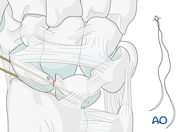 Lesser arc, scapholunate ligament injury - insertion of a suture anchor