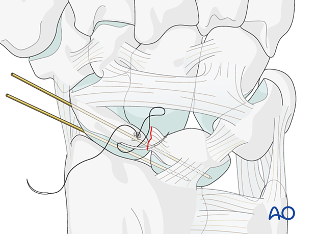 Lesser arc, scapholunate ligament injury - insertion of a suture anchor into the torn end of the ligament and tying it.