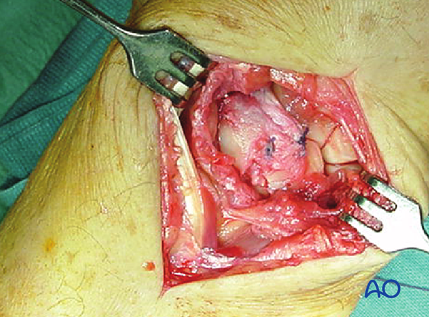 Carpus – Complete dislocation of the lunate – ORIF – Open reduction internal fixation