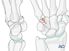 Hamate hook fracture – ORIF – Screw fixation