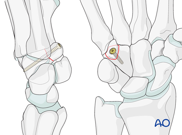 Hamate hook fracture –Screw fixation