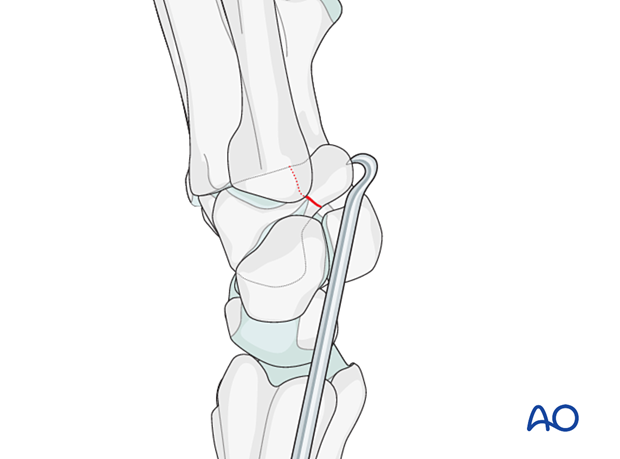 Hamate hook fracture –Reduction