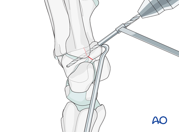 Hamate hook fracture – Screw fixation: drilling