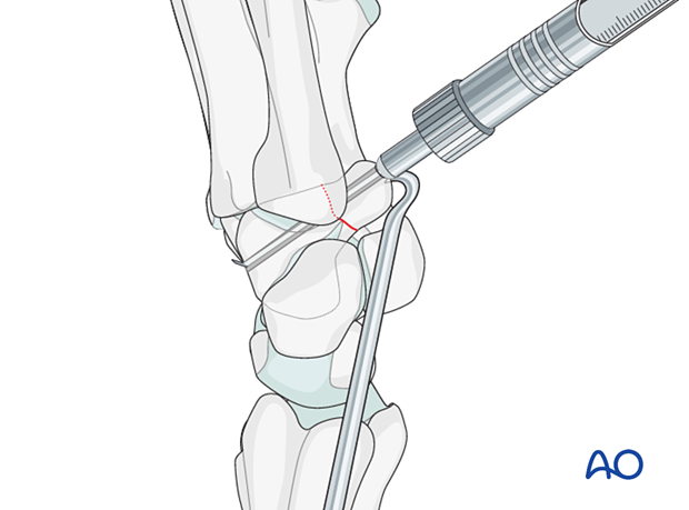 Hamate hook fracture –Screw fixation: measuring screw length