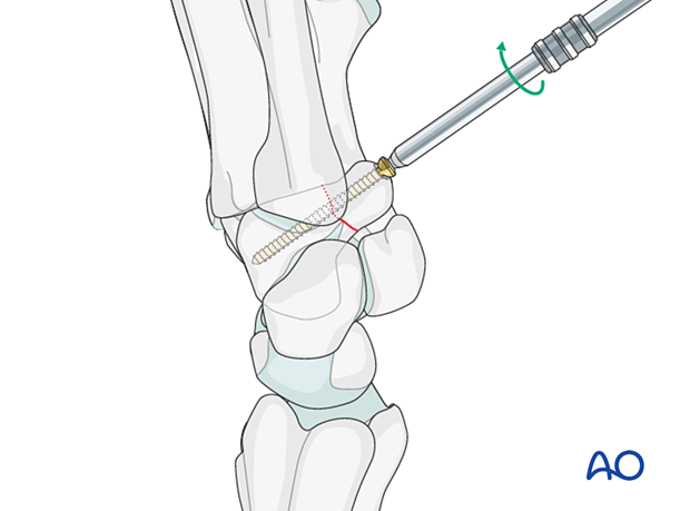 Hamate hook fracture – Screw fixation: screw insertion