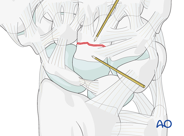 Capitate fracture reduction with K-wire joystick technique