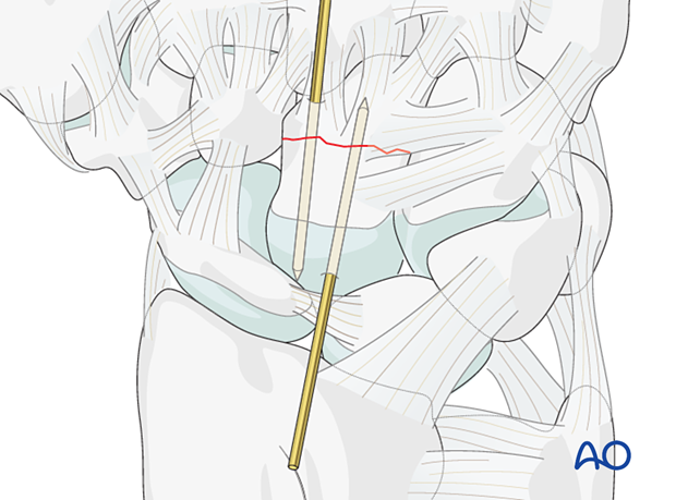 Temporary stabilization of a capitate fracture with K-wires