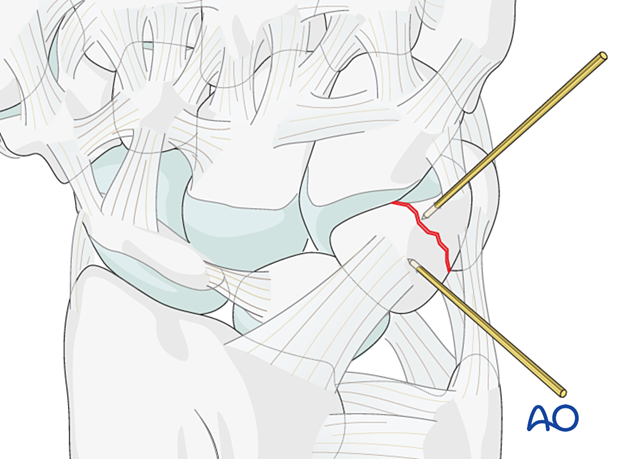 Triquetrum fracture: reduction with K-wire joystick technique