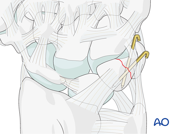 K-wire fixation of a triquetrum fracture