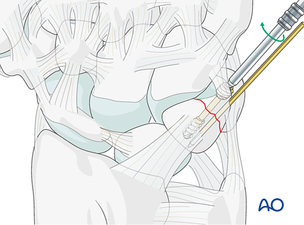 Insertion of a headless compression screw for fixation of a triquetrum fracture