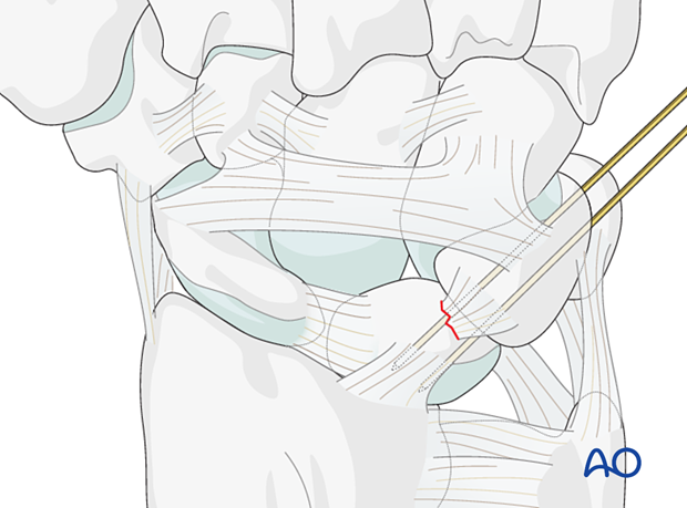 K-wire transfixation of the lunotriquetral joint