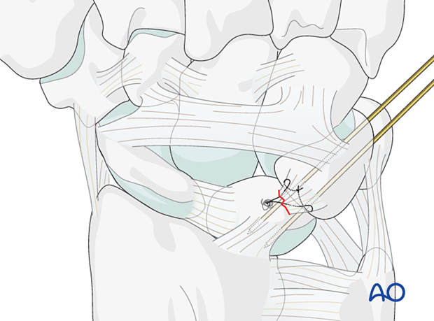 Lunotriquetral ligament repair with a suture anchor and K-wire joint transfixation