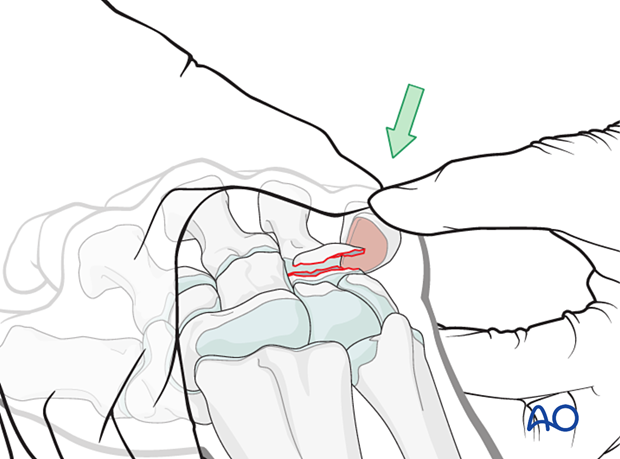 Manual reduction of a CMC fracture-dislocation