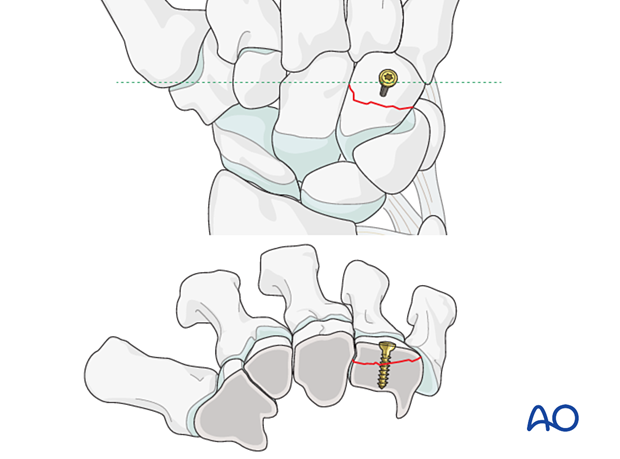 Fixation of hamate fracture with a miniscrew