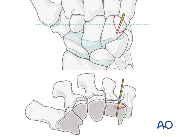 Fixation of hamate fracture with a K-wire