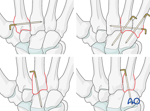 K-wire stabilization of carpometacarpal joints