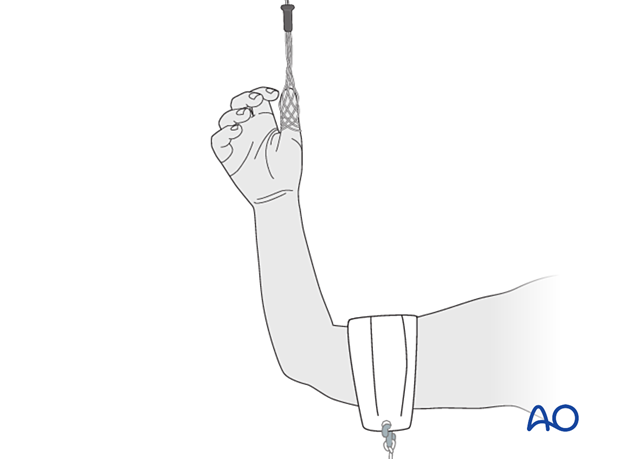 Thumb suspended in a finger trap to apply traction to assist reduction of fragments and/or dislocations in the wrist