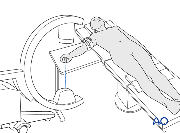 Image intensifier positioned so the operating surgeon has good access to the wrist