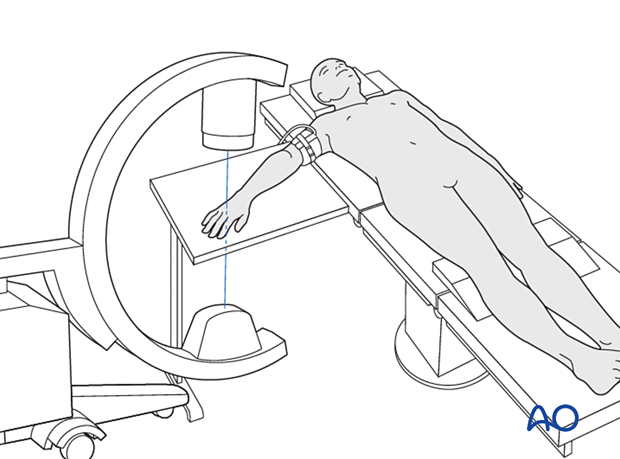 Image intensifier positioned so the operating surgeon has good access to the wrist