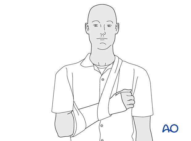 Patient with arm in a well-padded below-elbow splint