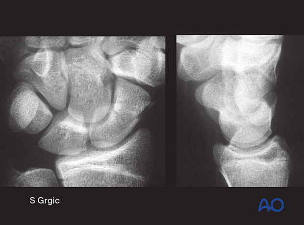 AP and lateral x-rays show a fracture line across the waist of the scaphoid with normal carpal alignment.