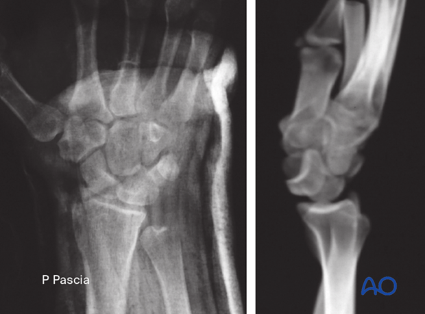 72_X010_i030 AP and lateral x-rays of a lunate dislocation. In the lateral view, the so-called spilled-teacup sign is clearly visible.